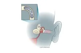 Ilustracija notranjega ušesa pri BPPV — najpogostejšem vzroku vrtoglavice v postelji